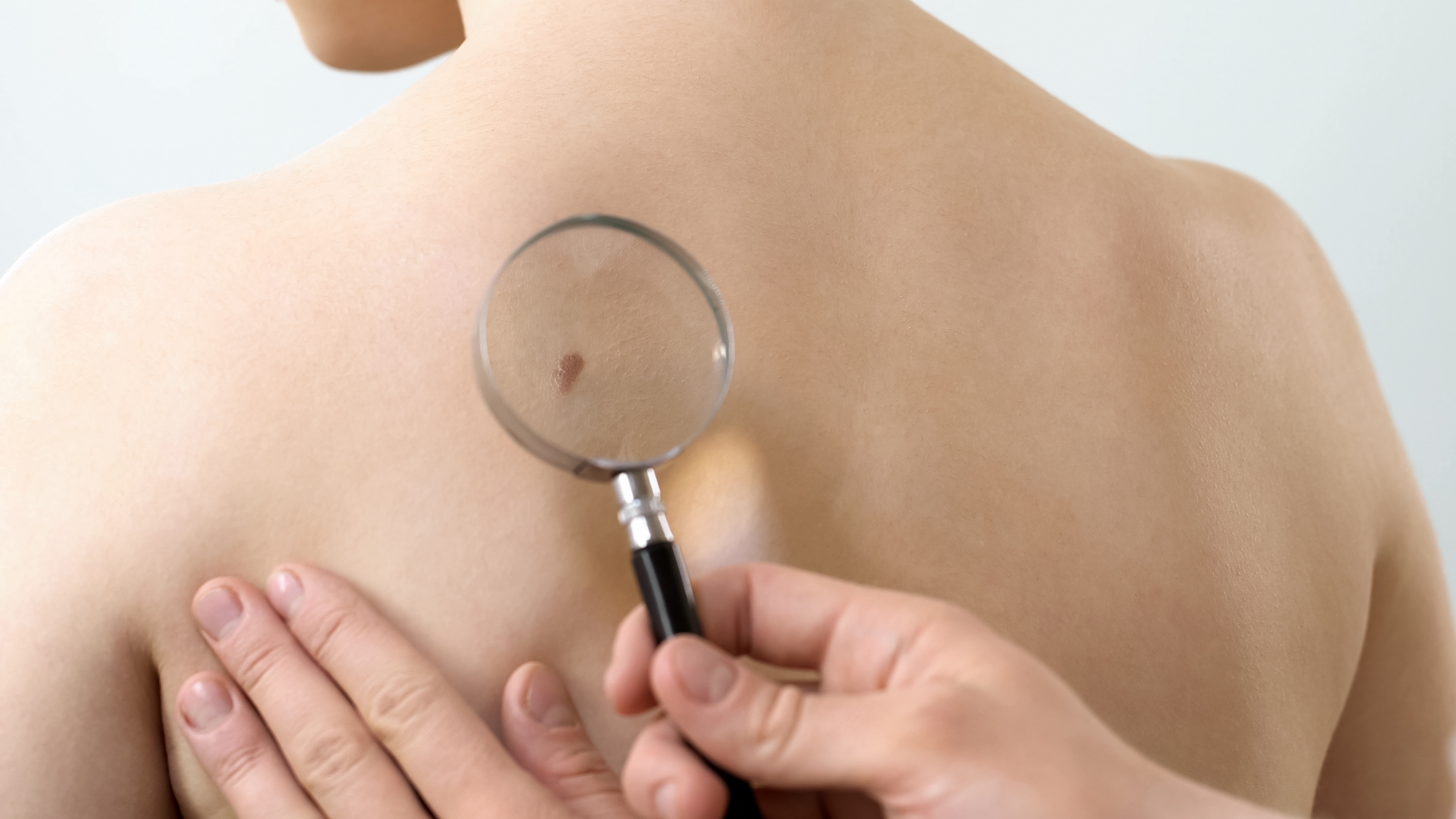 photo of skin cancer exam