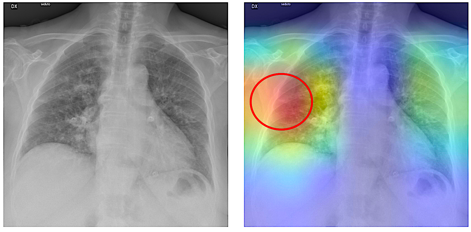 Double image of Chest X-Ray before and after AI analysis