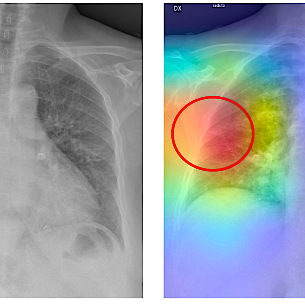 Double image of Chest X-Ray before and after AI analysis