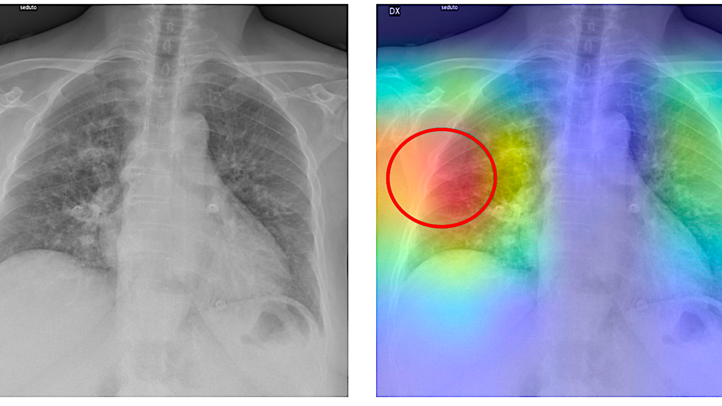 Double image of Chest X-Ray before and after AI analysis