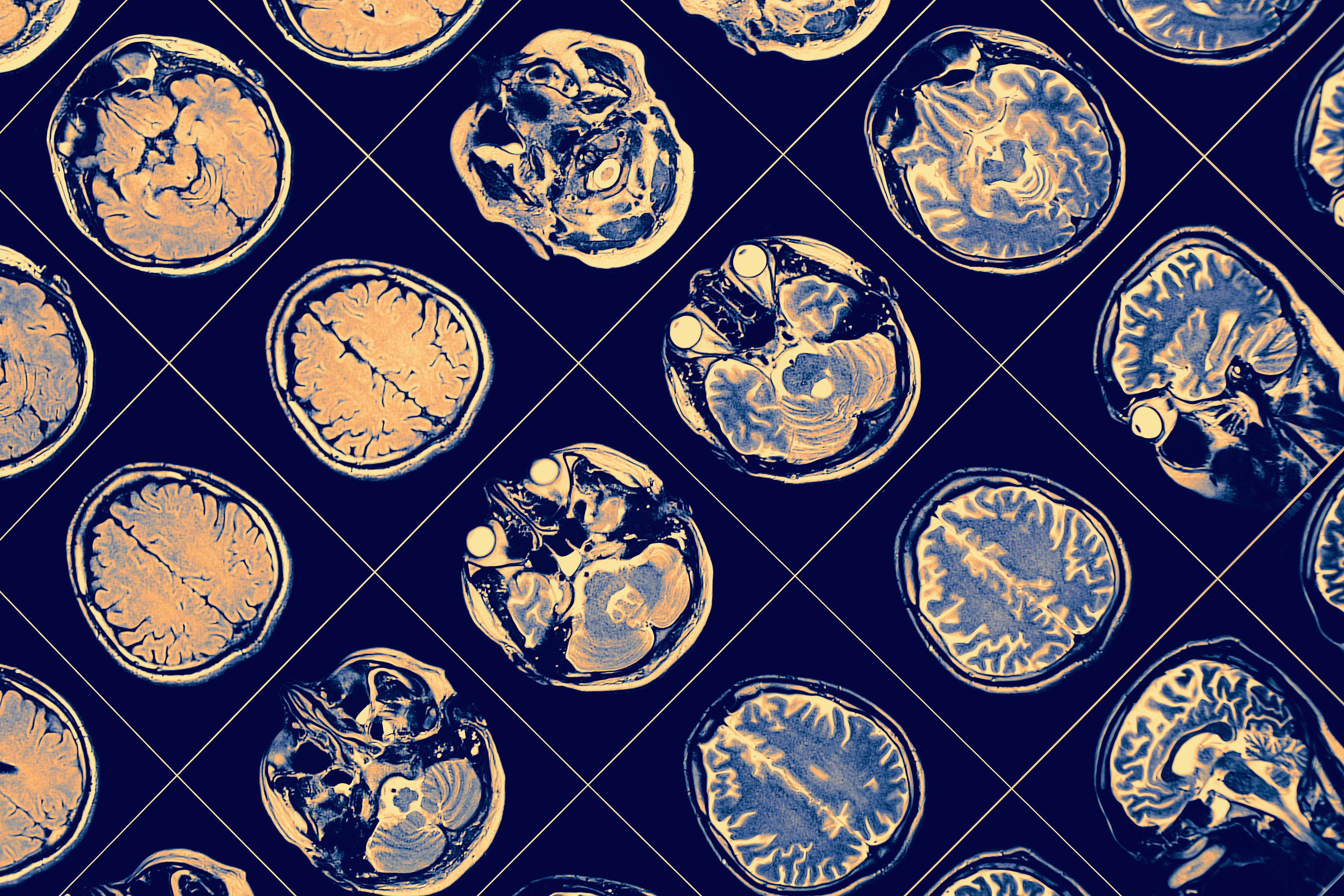 Rows of MRI images of the brain