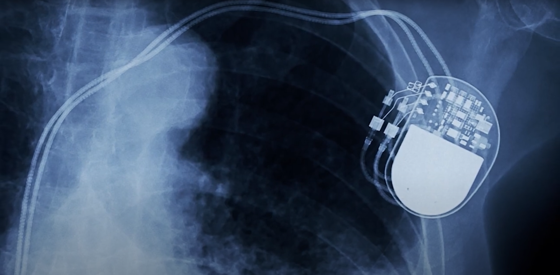 X-ray image of an implanted device in a human body. 