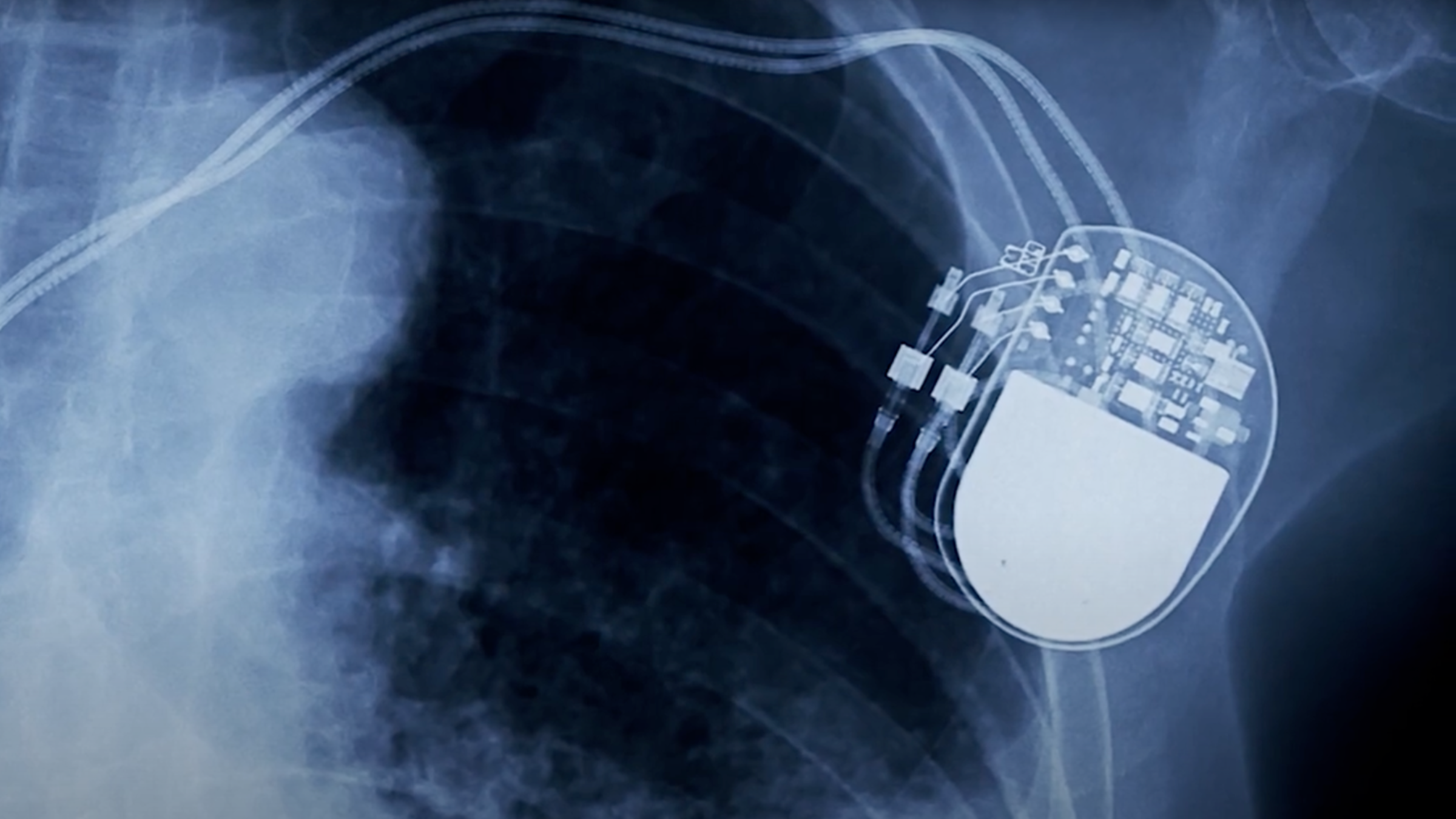 X-ray image of an implanted device in a human body.