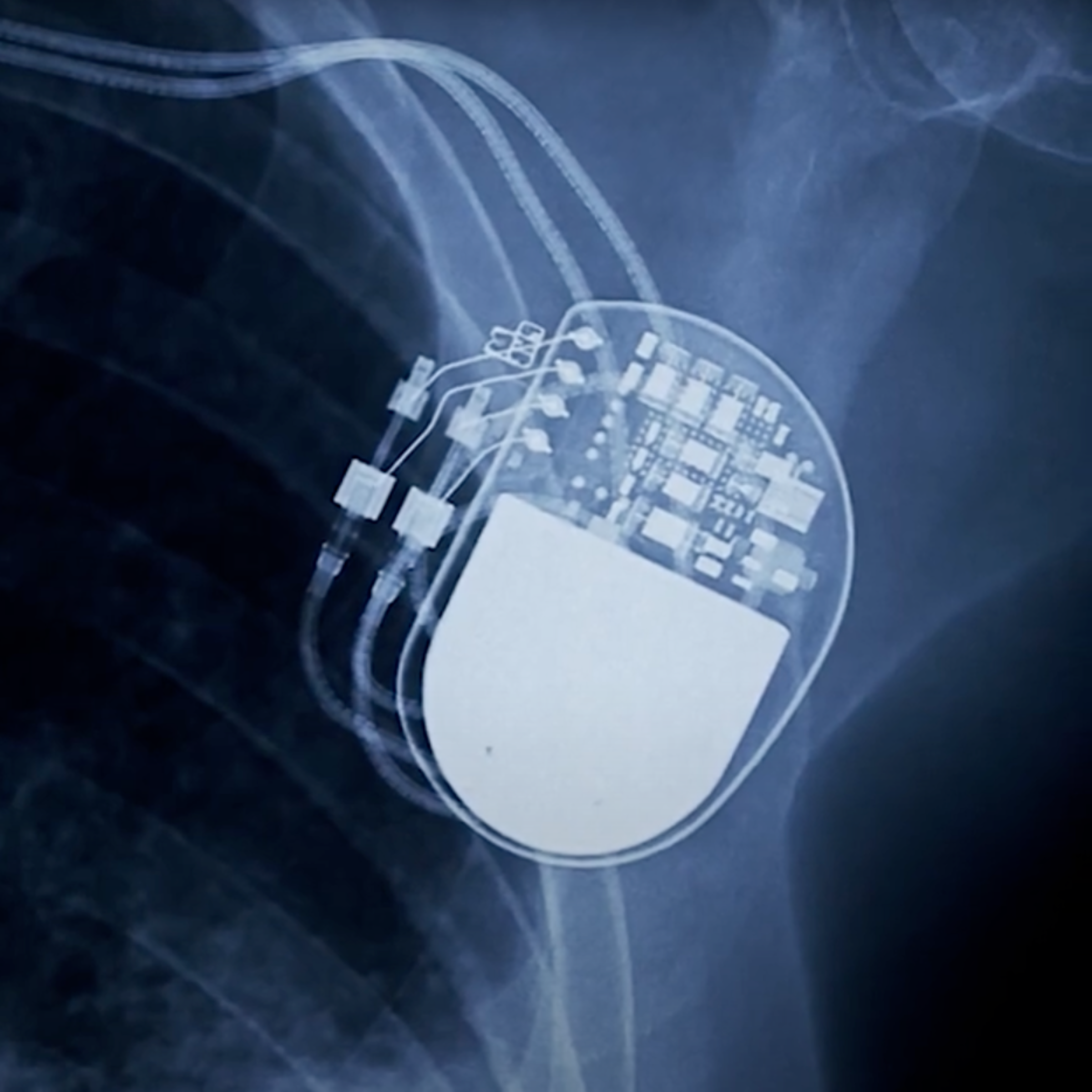 X-ray image of an implanted device in a human body.