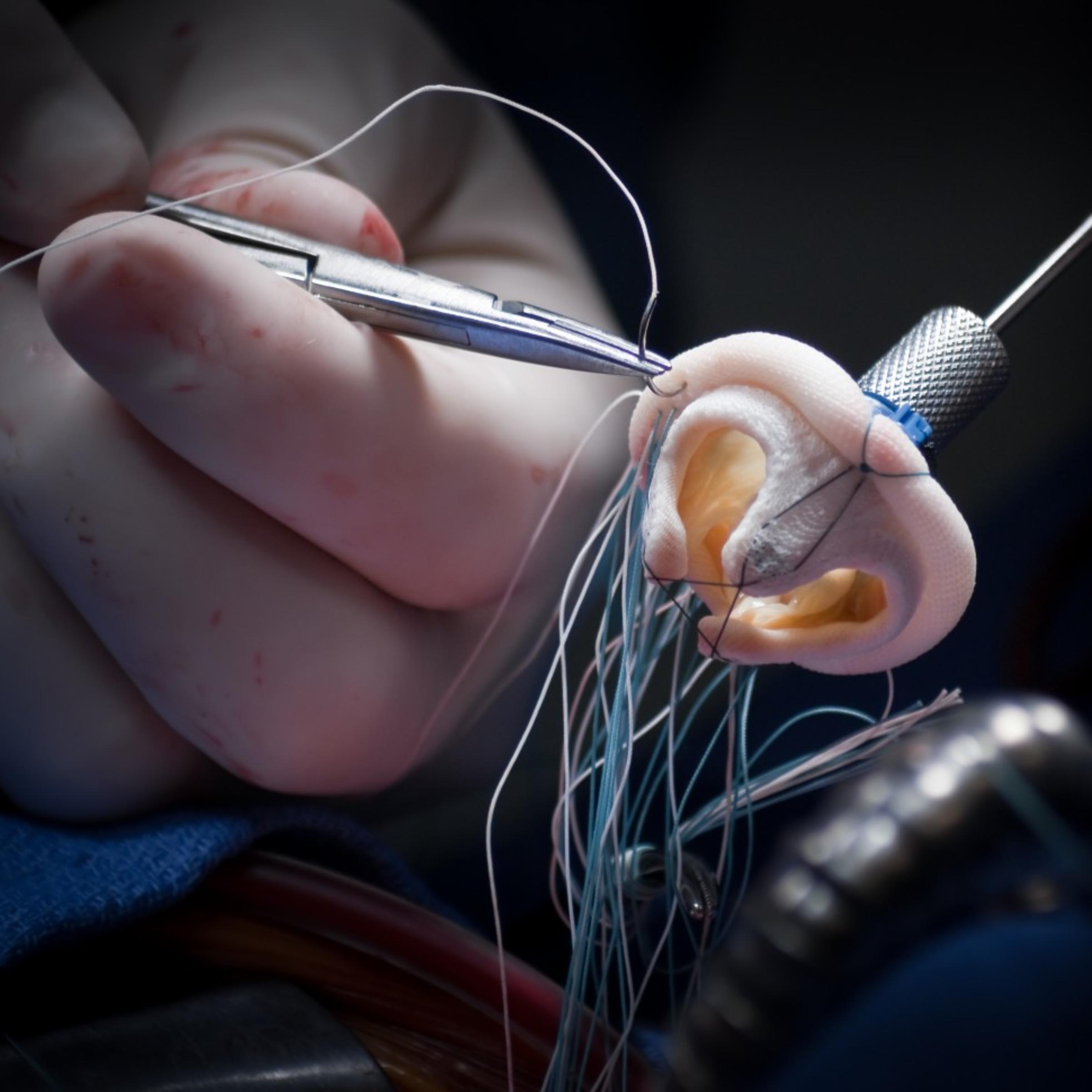 A photo of a medical implant during surgery