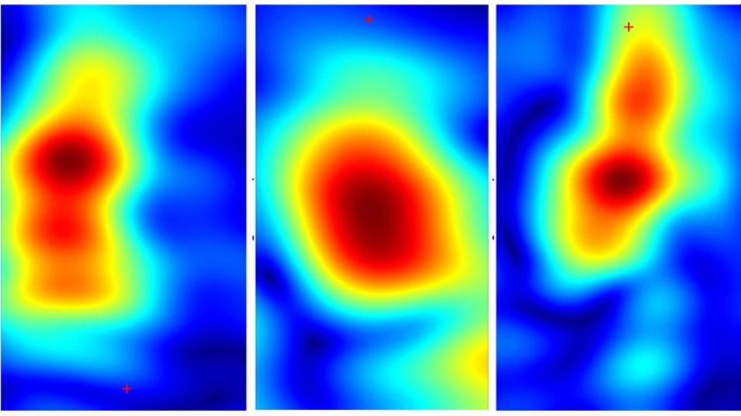 Bye, Bye, Biopsy? Handheld Device Could Painlessly Identify Skin Cancers
