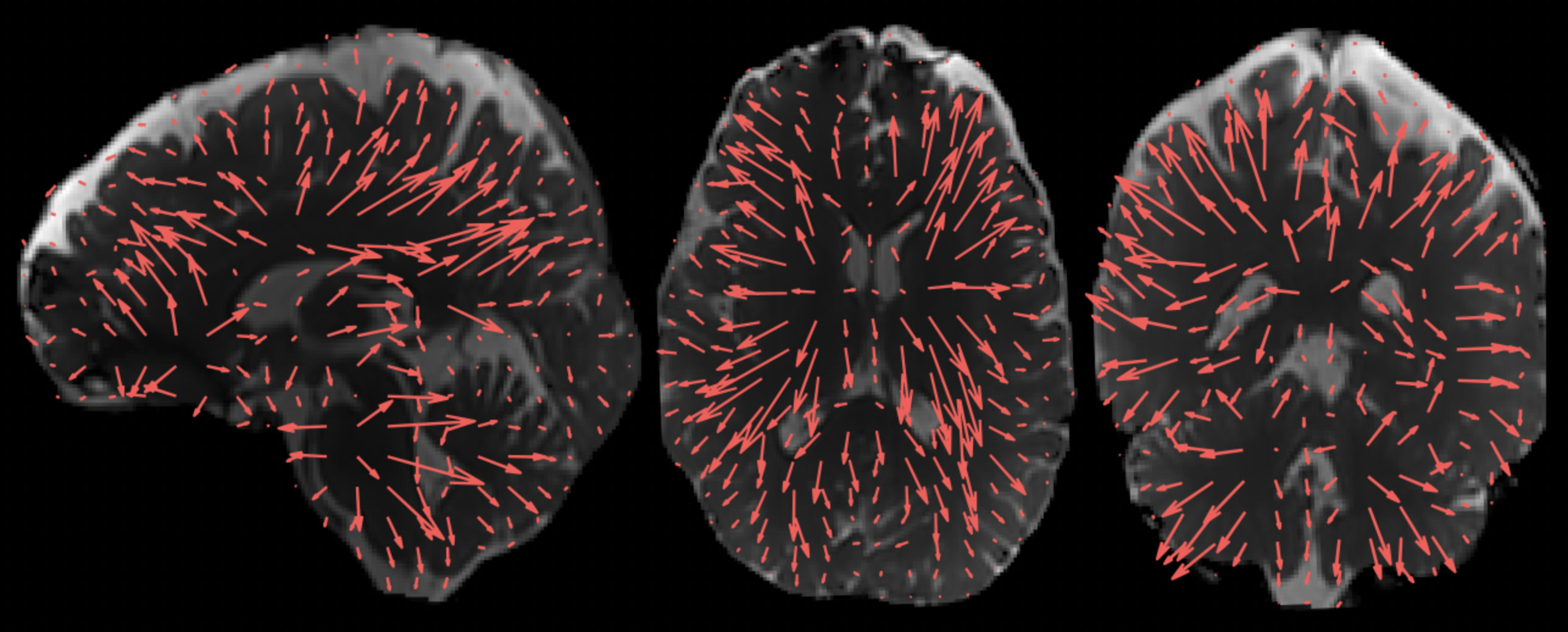 Three slices of the brain with red arrows within them. Each red arrow is a different length and width, corresponding to the direction and amplitude of the brain moving in three dimensions.