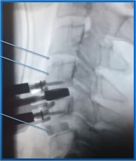 X-ray of a lower lumbar spine
