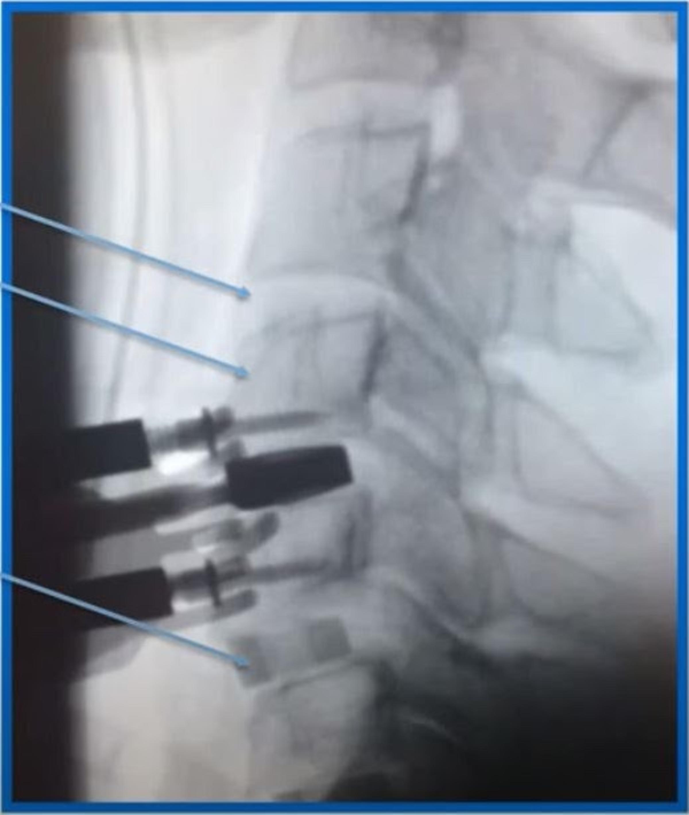 X-ray of a lower lumbar spine