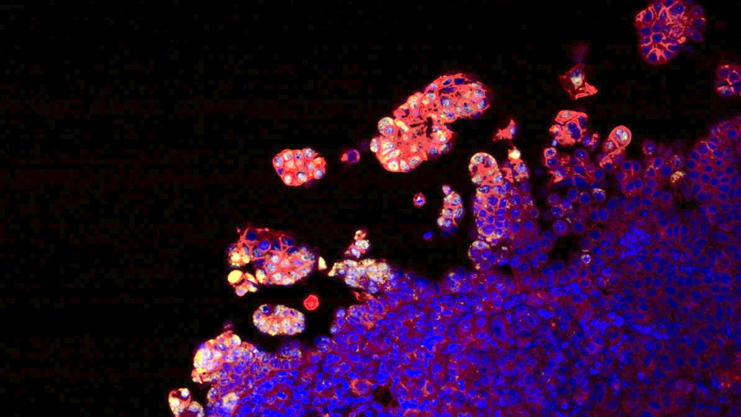 image of cancer cells