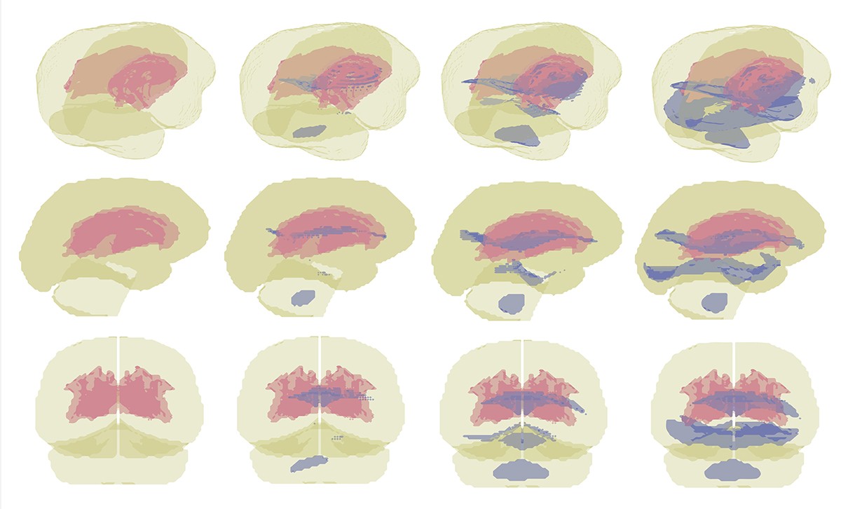 three rows of 4 brain images, sagital, coronal and 3D